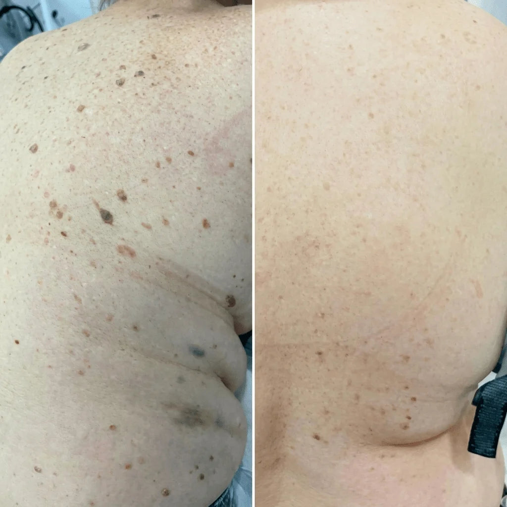 Customer-submitted before and after image of body skin