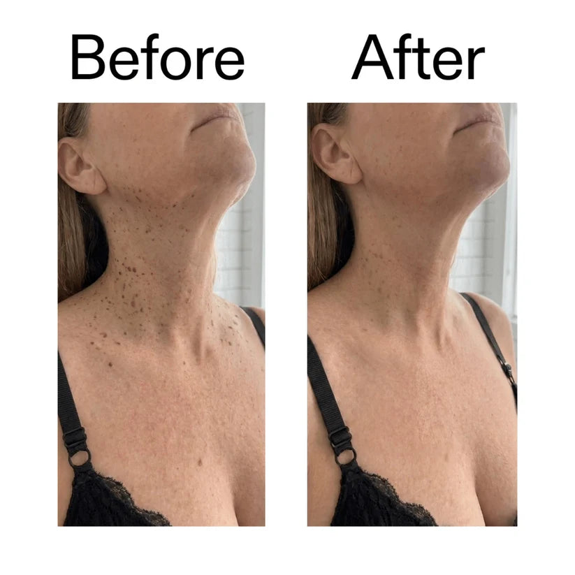Customer before and after result on neck and chest
