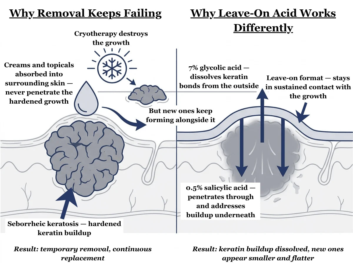Illustration comparing spot removal with a leave-on exfoliating routine