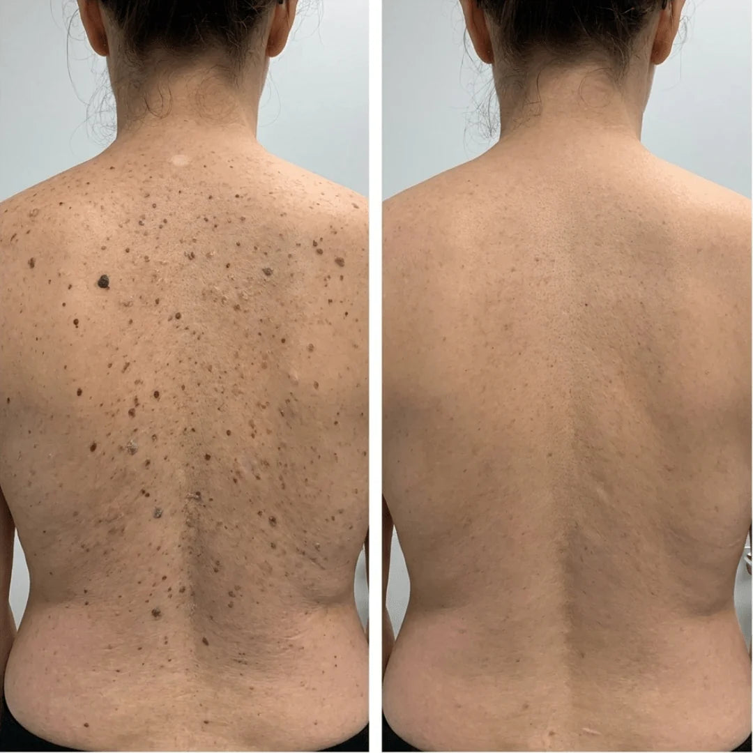 Customer-submitted before and after image of back skin
